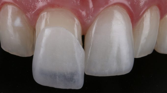 Procedimentos de estética dental na Zona Norte de SP