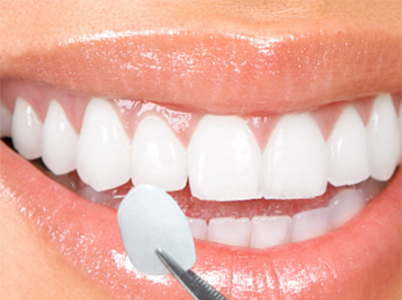 Lentes de contato dental na Zona Norte de SP