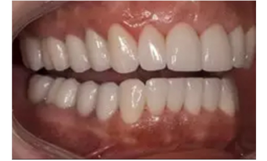 Facetas dentais na Zona Norte de SP