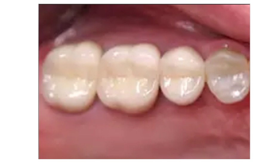 Clareamento dental na Zona Norte de SP