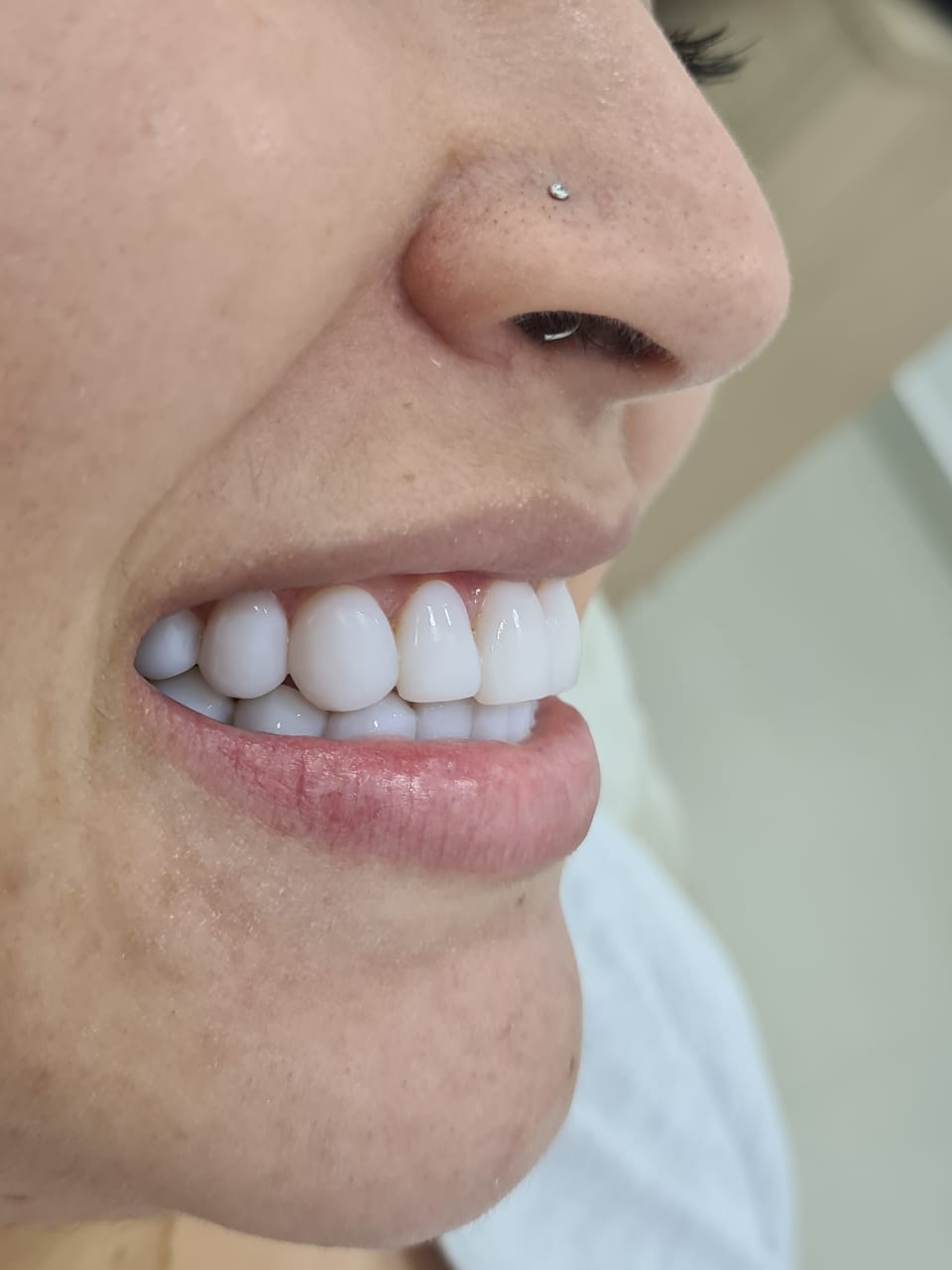 Implante dentário na Vila Sabrina SP