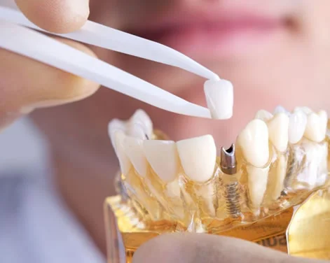Implante Dentário
